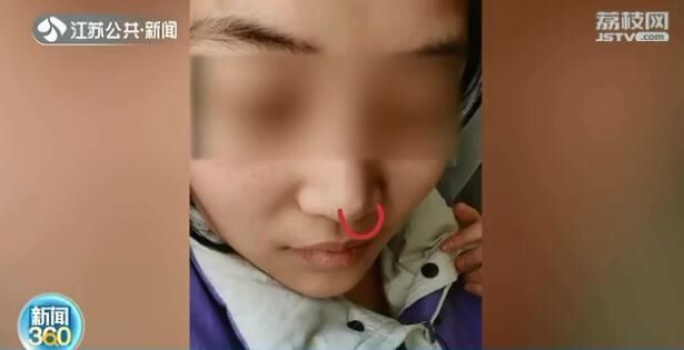 女子隆鼻后长出硬疙瘩 想退钱却找不到人