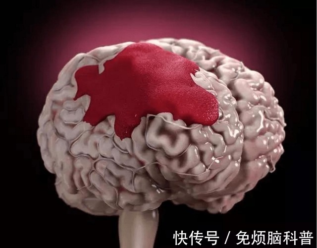 睡眠质量|高血压患者,易诱发脑出血,日常注意这些细节,可以避免血压突升