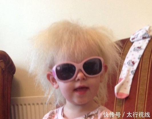 安德伍德|因患有难梳头发综合征,这个小女孩,拥有了爱因斯坦同款发型