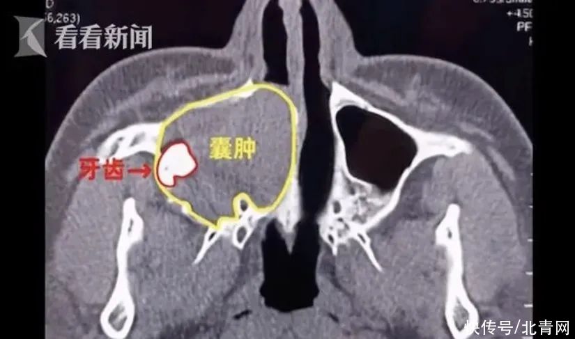 男子|男子右眼莫名流泪，一查竟是鼻腔长了牙