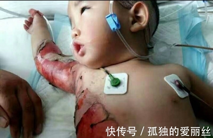 妈妈|三岁小女孩碰中开水壶,重度烫伤,妈妈喊到:没别忙活了,让她走