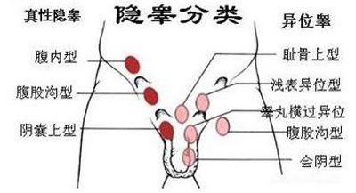 异位|孩子只有一个蛋蛋！医生：极少见的睾丸横过异位