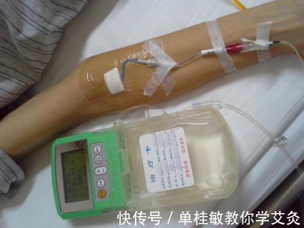 老人|80岁老人癌症晚期有必要化疗吗?