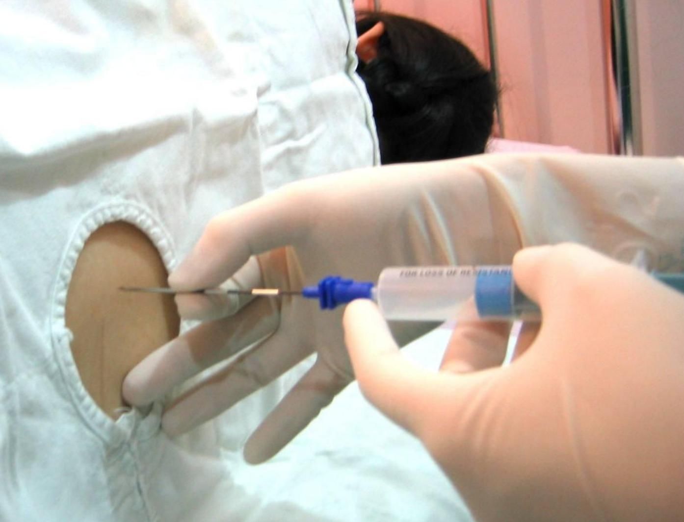 产妇|剖腹产有全麻不要紧?别小瞧剖腹产,10公分的腰椎穿刺针才是开始