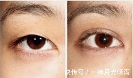内眦赘皮 开眼角手术怎么做才能不留疤隆鼻能改善眼角吗!