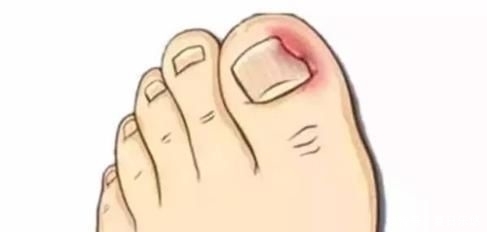 真人|甲沟炎发作,不敢走路,老药师用一味药止疼真人在民间