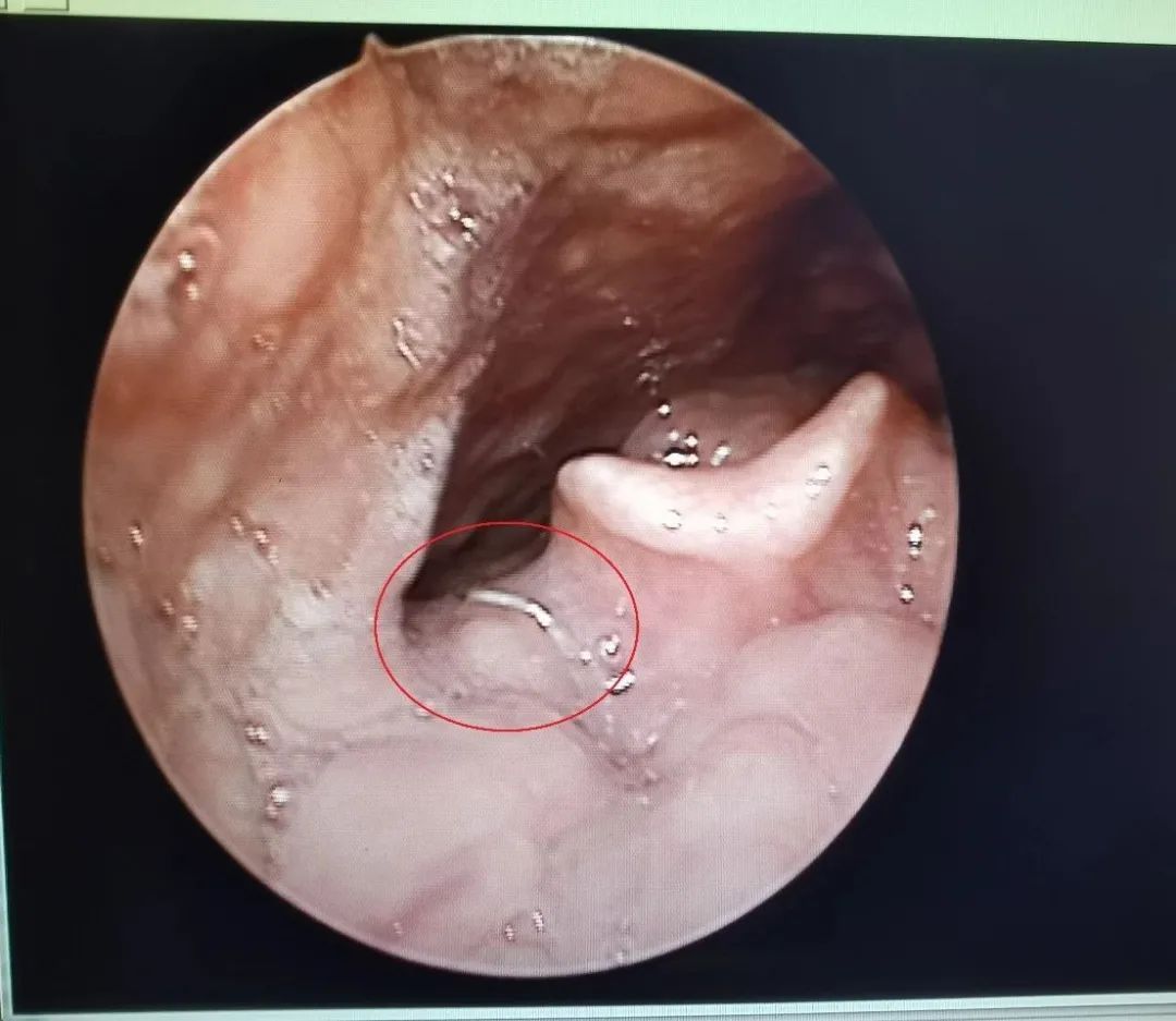 咽部|这东西赵县几乎家家都在使用,一定要注意安全!