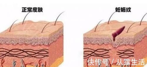 腹部|妊娠纹是怎么产生的？网友用塑料袋像大家展示，简直不要太形象
