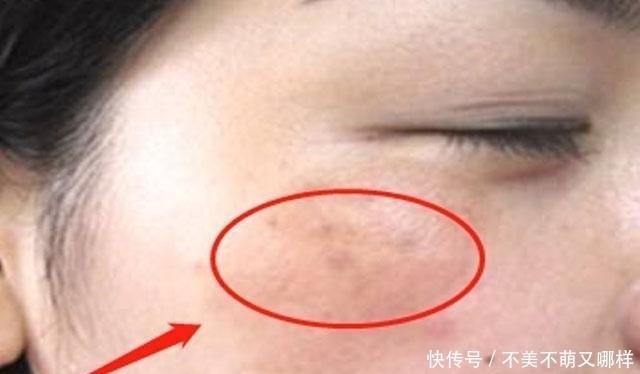 黄褐斑|子宫健康的女性，脸上不会有4种表现，常喝1种水，子宫更光滑