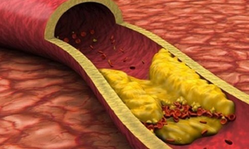 小动脉瘤|确诊高血压后,给你提个醒,少吃4类食物,对控制血压有好处