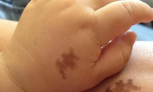 孕期|不想宝宝出生后有胎记?孕期尽量避开三点,或许有助于胎儿发育