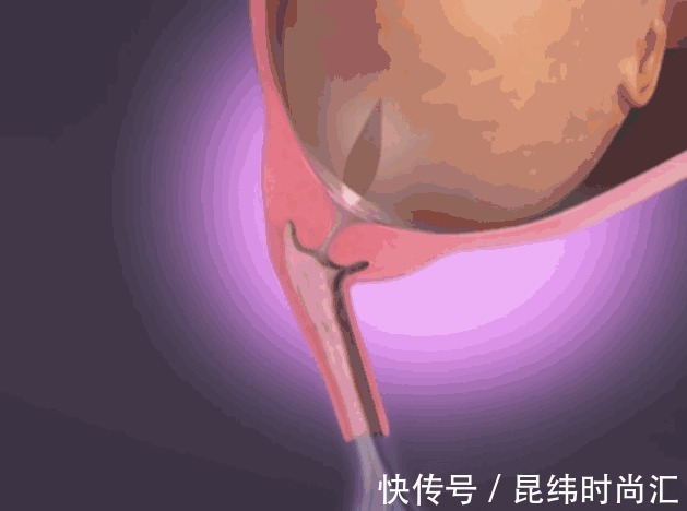 分娩|胎儿分娩前在忙什么?忙着收拾东西出来呢,过来人的说法很真实