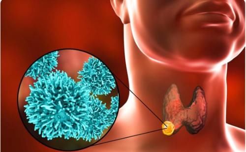 存活率|甲状腺癌真正能活几年?这是见过最科学、合理的解释!