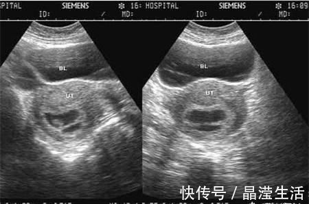 胎芽|怀孕两个月，检查没有胎心胎芽，检查只有个空壤这是什么情况啊？