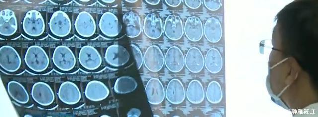 胎记|4岁女童头上的胎记,一查竟是血管瘤,医生给出了答案