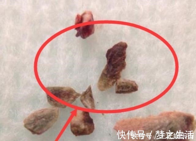 散散步|孩子被嘲笑“嘴太臭”,被同学孤立,医生取出小颗粒,宝妈都嫌臭