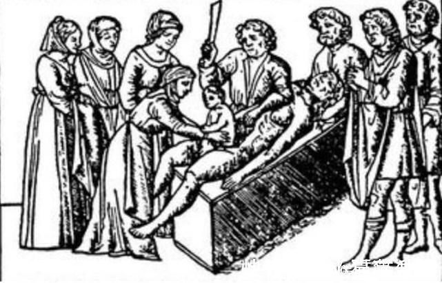 矫情|剖腹产比顺产轻松?看完这些“手术工具”,别再说女人“矫情”