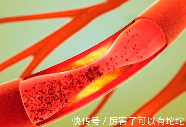 血脂|血管堵塞想疏通，若想血脂健康，謹記：“2戒、3勤、4堅持”