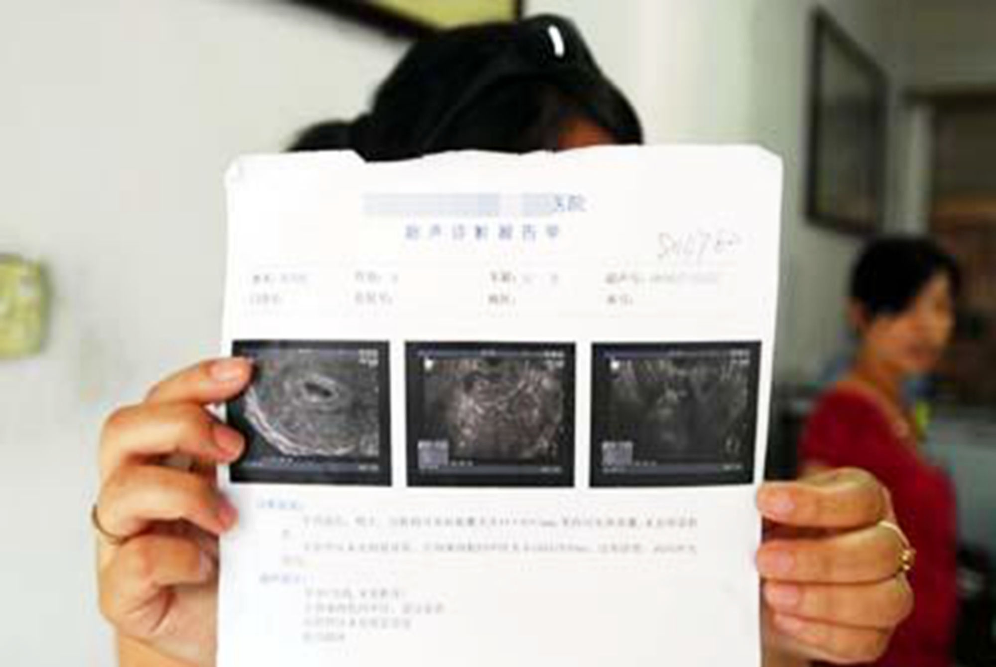 孕囊|孕早期B超单上的四个指标,暗含了胎儿的“小秘密”,你看得懂吗