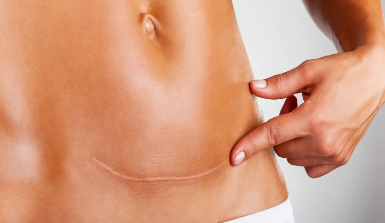 三胎|“横剖”与“竖剖”,哪个对二胎、三胎影响更大?这个选择很重要