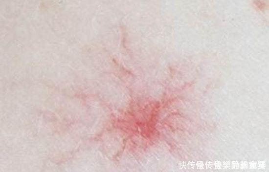 皮肤过敏|皮肤出现四种异常,别傻傻的认为是皮肤过敏,有可能是肝病的前兆