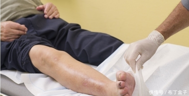 手脚|糖友们请当心，当手脚出现这些症状，糖尿病足或许已经不远了