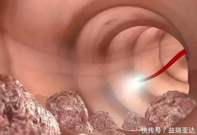 27岁女子，查出肠癌，无奈放弃治疗，提醒：1种食物不能天天吃