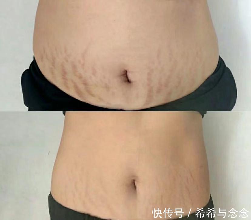 揭秘|揭秘!预防妊娠纹就像“抽盲盒”!既要有运气也要靠科学!