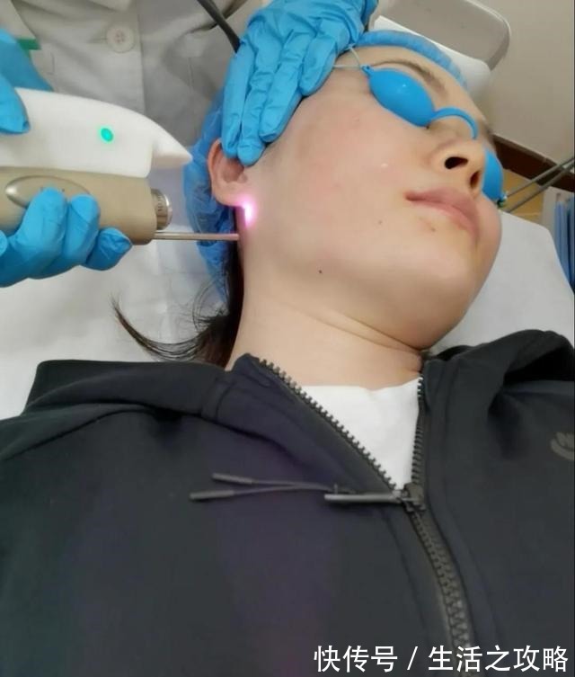 热玛吉 不吹不黑不P图,卡戴珊同款医美真实效果如何!