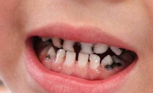 家长|想要宝宝牙齿洁白,这3点家长要做好,帮娃告别“小黑牙”