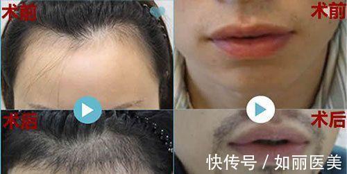 技术 植发技术好不好?植发和微针植发哪个好?优缺点分析