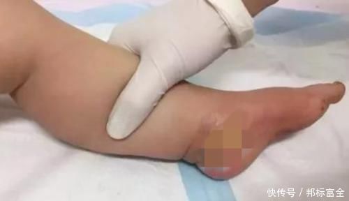 纽扣电池|孩子被开水烫伤,先脱衣服还是先冲水顺序做错伤情更严重