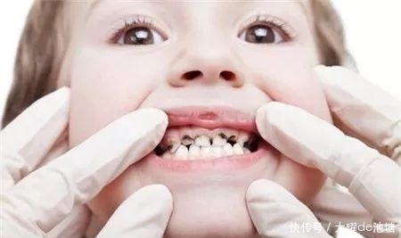 龋齿|乳牙龋坏会危害孩子全身,还在等换牙可能就晚了