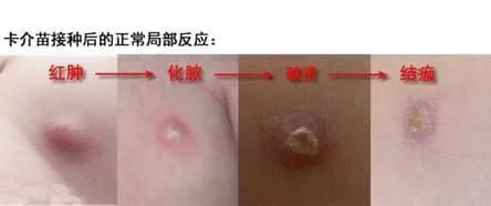 宝宝胳膊上突然长红疙瘩，原来是卡介苗的接种反应