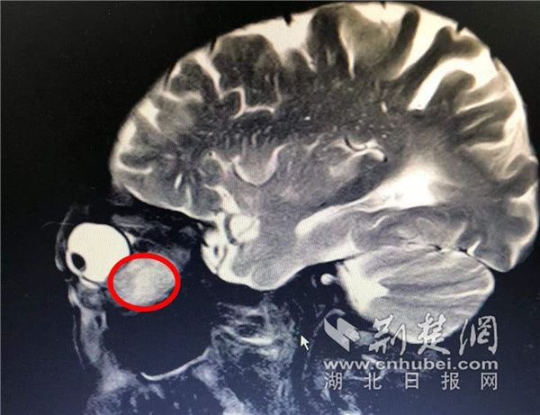 肿瘤|爹爹患胃癌眼眶里却长肿瘤医生抽丝剥茧保住眼球