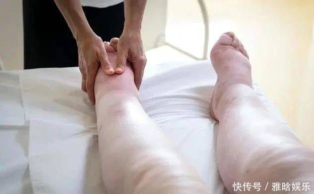 糖尿病者，身体出现4种表现，或是尿毒症“找上门”，莫忽视