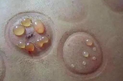 拔火罐真的能够排毒吗 拔出的水泡真的是