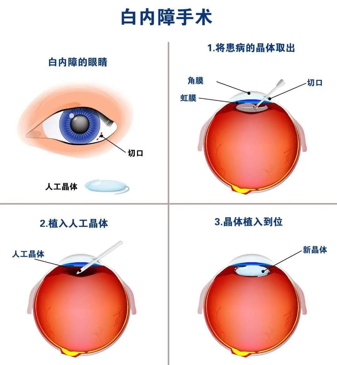 山东中医药大学|白内障手术做了以后又看不清了，难道白挨了刀？！