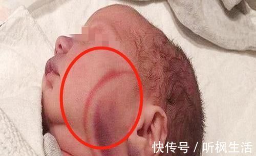 婆婆|宝宝出生有“产钳印”,婆婆责儿媳没本事,心凉啊