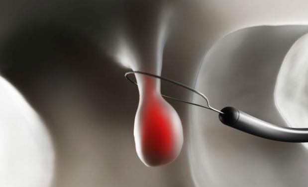 结直肠息肉|四个部位的小病要及时治疗，如果拖就会变成恶性肿瘤！了解一下！