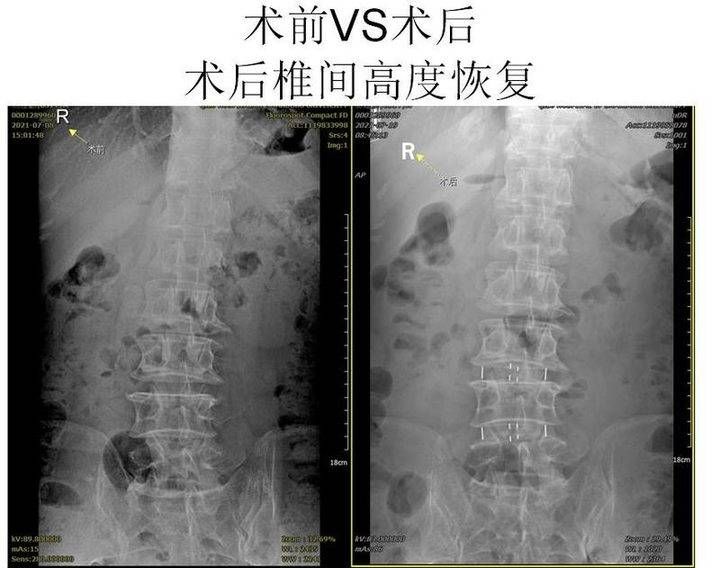 王志刚|腰椎问题也可微创，山大齐鲁医院（青岛）为多名患者实施手术