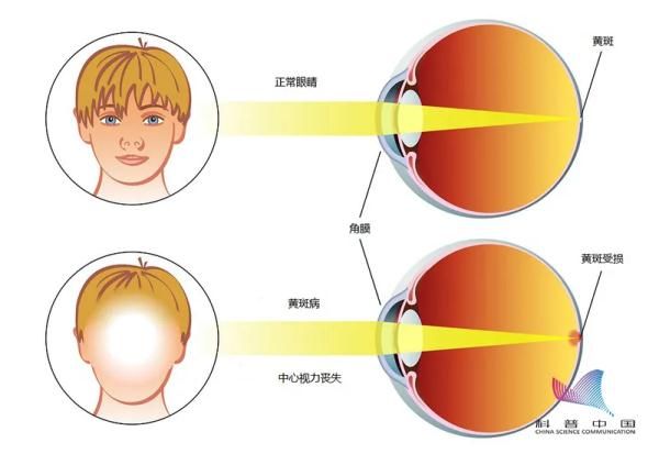 青光眼|谣言还是真相？关灯玩手机会导致失明？