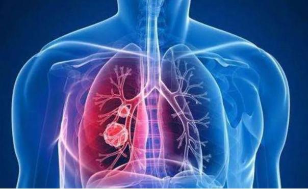 陈皮|患肺结节的人越来越多多吃2黄,或有助于结节消散,保护肺部