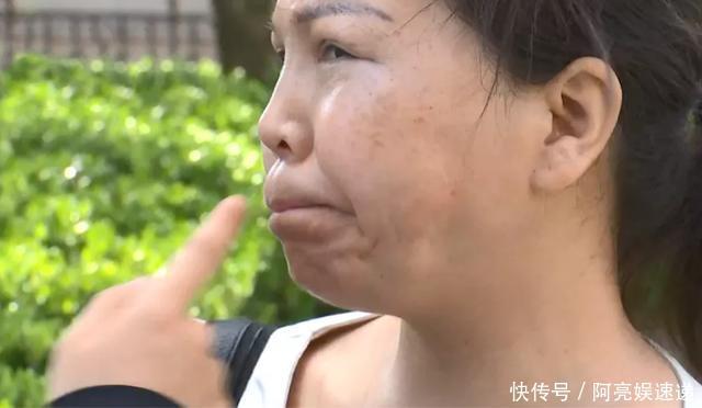 做完抽脂后,女子脸上多出两个鼓包,还因此失去两段“姻缘”