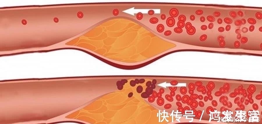 克星|这些食物堪称高血脂“克星”, 常吃血脂不高, 血管越来越通畅!