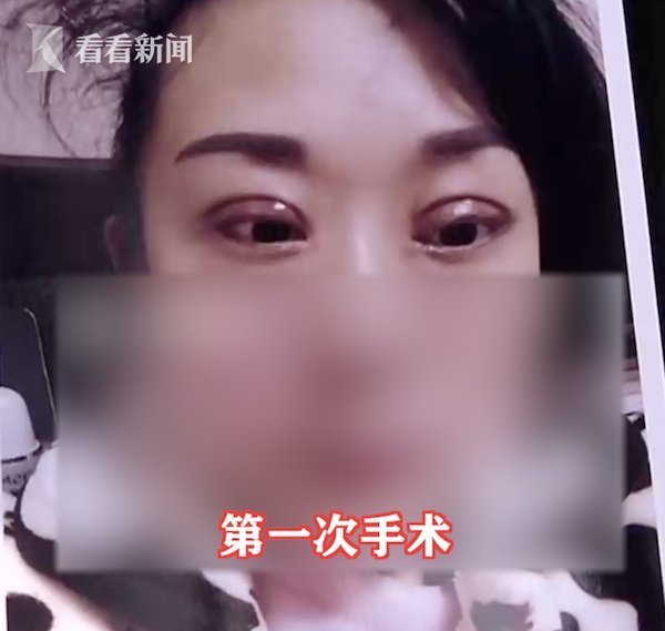 离婚|女子花2万割双眼皮3个月没消肿 老公要离婚