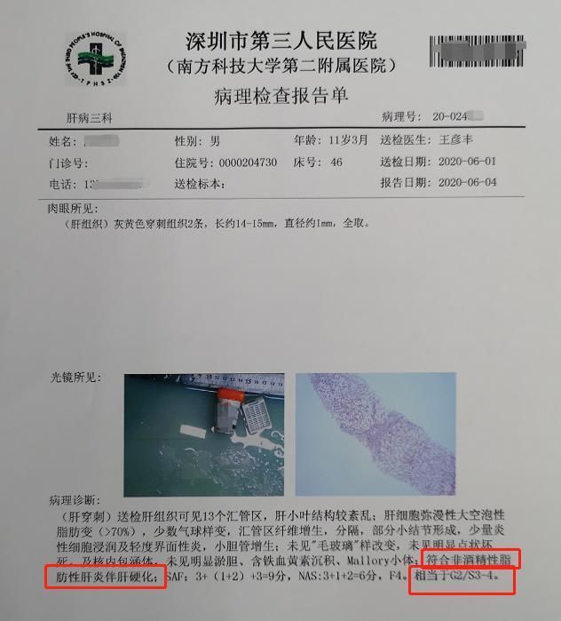 脂肪肝|11岁男孩重度肝硬化!医生检查后发现:罪魁祸首为所有人敲响警钟!