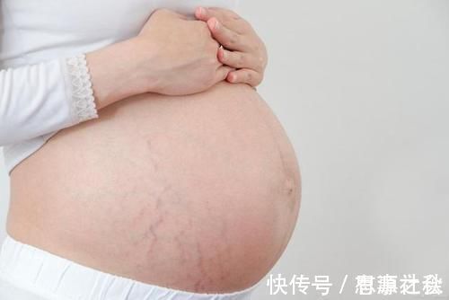 激素|“毁容式”怀孕之妊娠纹：10个孕妈9个长纹，教你咋应对咋预防