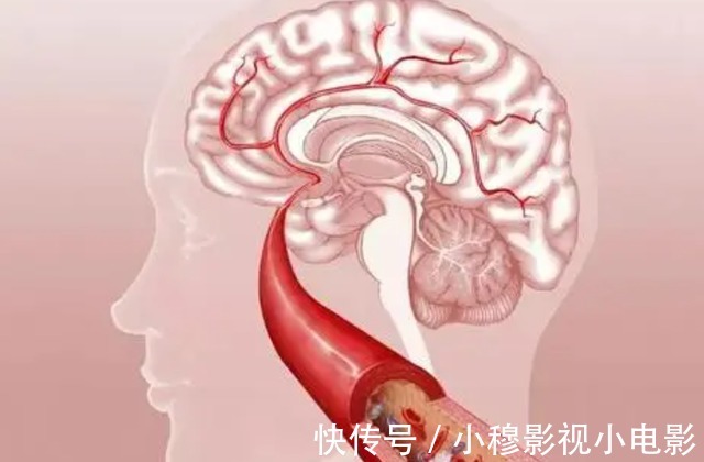 高血压|高血压达到多少,会引起脑溢血?提醒:最好别超过这个范围