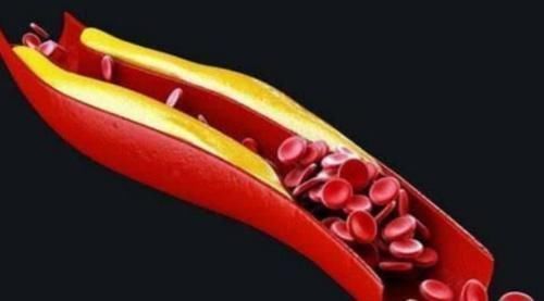 高脂血症|喝水与高血脂的关系不一般，正确饮水，大夫支3招，血脂更加平稳